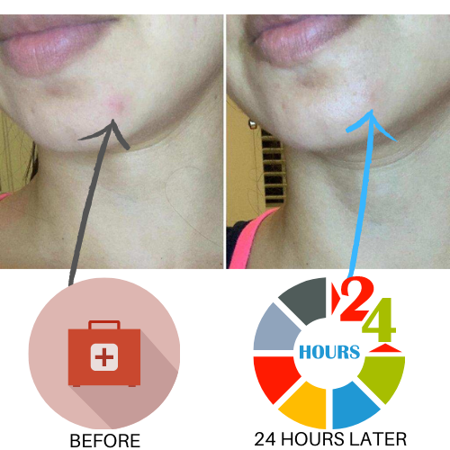 Truly Clear Acne Bar