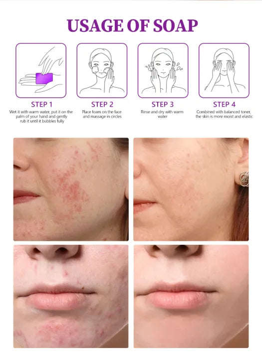 Beauty Anti Acne Fade Acne Marks Handmade Body and Face Soap-120g 4:1/ 4pc
