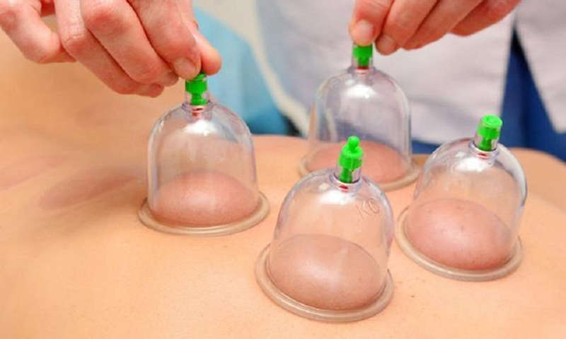 Chinese Body Cupping Massage Suction Therapy