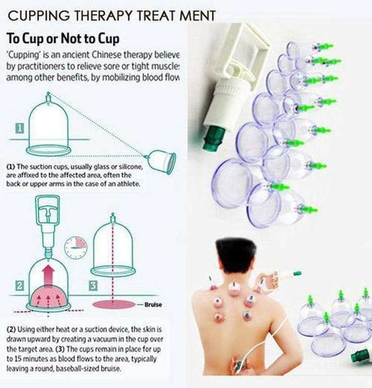Chinese Body Cupping Massage Suction Therapy