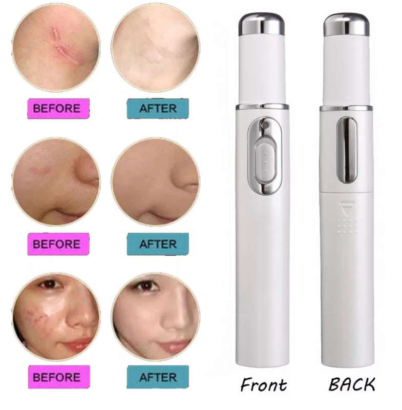 Acne Blue Ray Pen