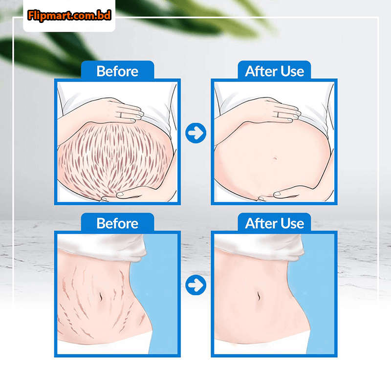 Snail Remove Pregnancy Scars Acne Cream Stretch Marks Treatment Maternity Rep
