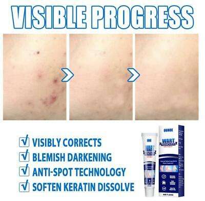 Wart Tags Remover Cream Antibacterial Extract Corn Plaster Warts Ointment
