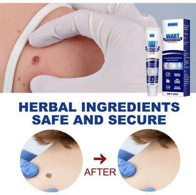 Wart Tags Remover Cream Antibacterial Extract Corn Plaster Warts Ointment