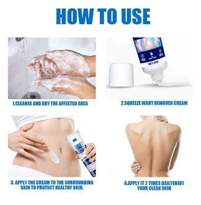 Wart Tags Remover Cream Antibacterial Extract Corn Plaster Warts Ointment