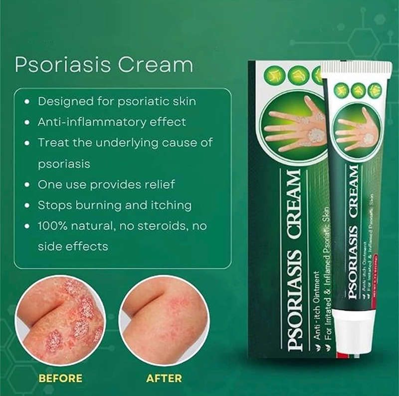 Skinmedix Psoriasis Cream, Zlimplify Psoriasis Cream, Psoriasis Control Face and Body Cream, Natu...
