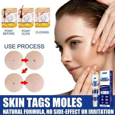 Wart Tags Remover Cream Antibacterial Extract Corn Plaster Warts Ointment
