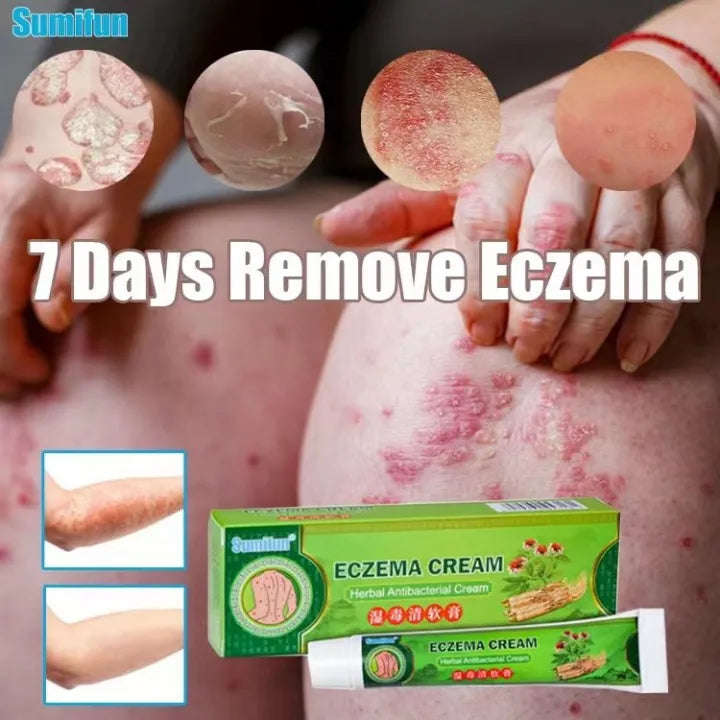 Effective Sumifun Eczema Treatment Cream gamot sa kati kati sa balat buni Psoriasis Treatment Cre...