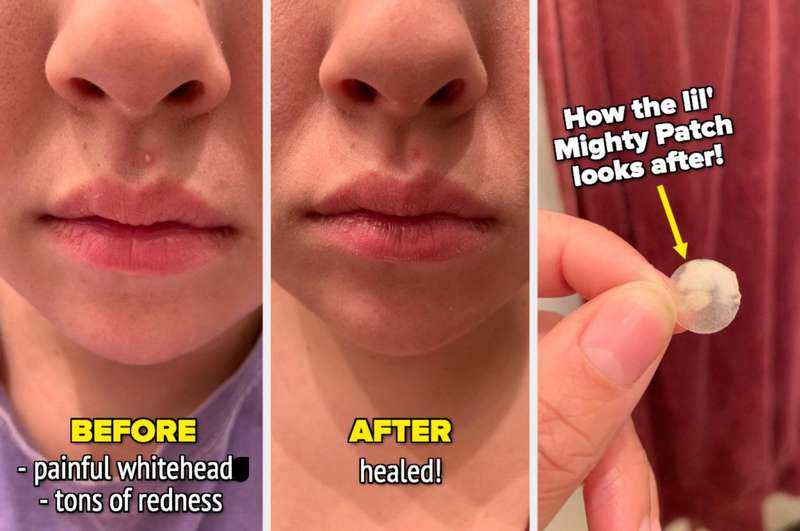 Acne Pimple Mighty Patch
