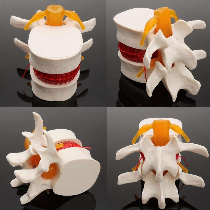 Human Lumbar Disc Herniation Demonstration Model Orthopedic Spine Model(Yellow)