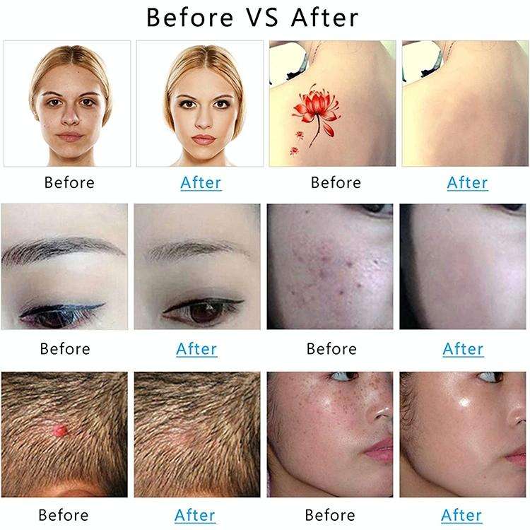 AA-A401 Small Freckle and Mole Removal Pen Tattoo and Eyebrow Removal Beauty Instrument, Color: R...