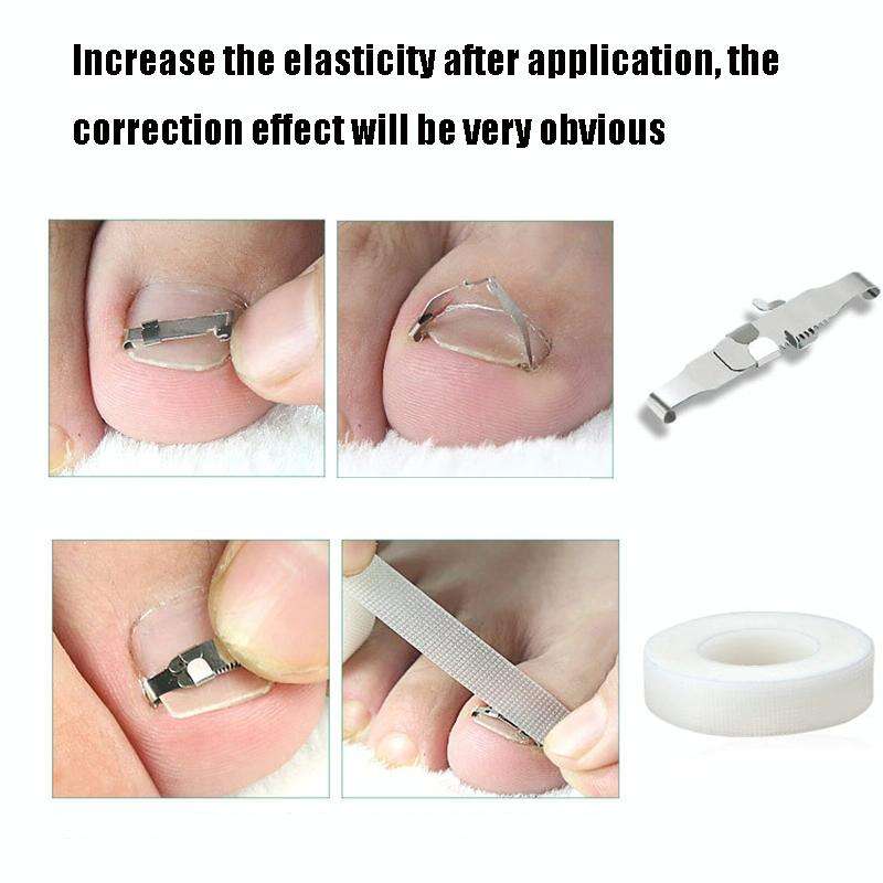 Orthopedic Buckle Toe Nail Groove Ingrown Nail Corrector, Style:No. 38, Specifications:Set