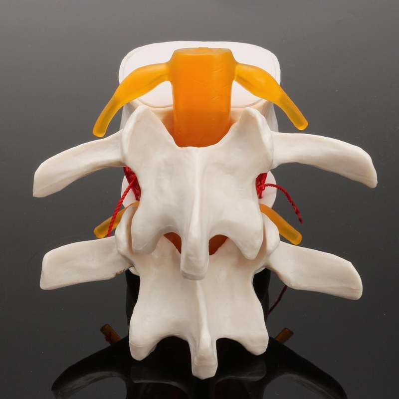 Human Lumbar Disc Herniation Demonstration Model Orthopedic Spine Model(Yellow)