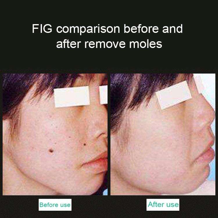 Handheld Picosecond Portable ( Removing Tattoo Freckle Mole Dot) Machine Laser Plasma Beauty Care...