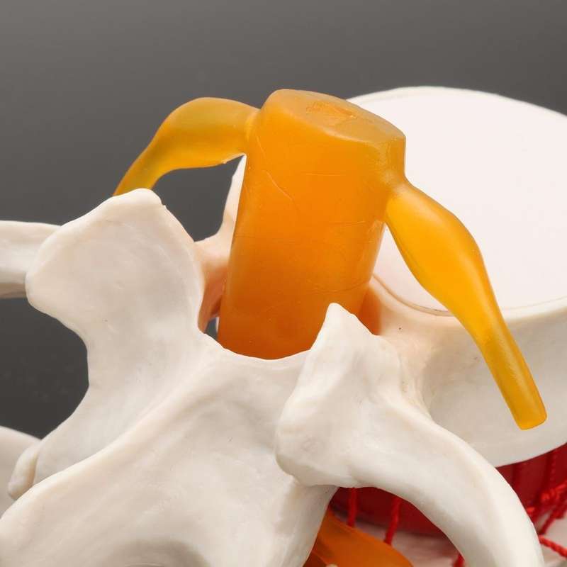Human Lumbar Disc Herniation Demonstration Model Orthopedic Spine Model(Yellow)