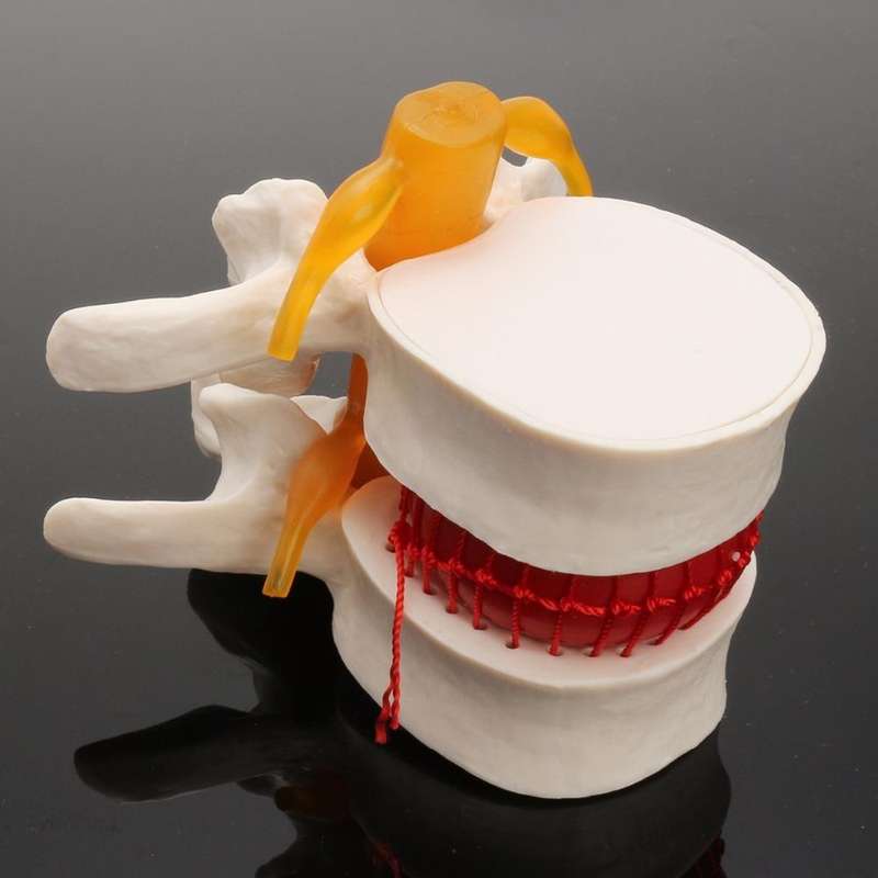 Human Lumbar Disc Herniation Demonstration Model Orthopedic Spine Model(Yellow)