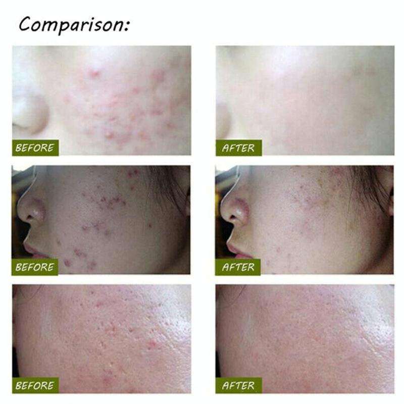 K-SKIN KD-7910 Acne Laser Pen Portable Wrinkle Removal Machine Durable Soft Scar Remover Device B...
