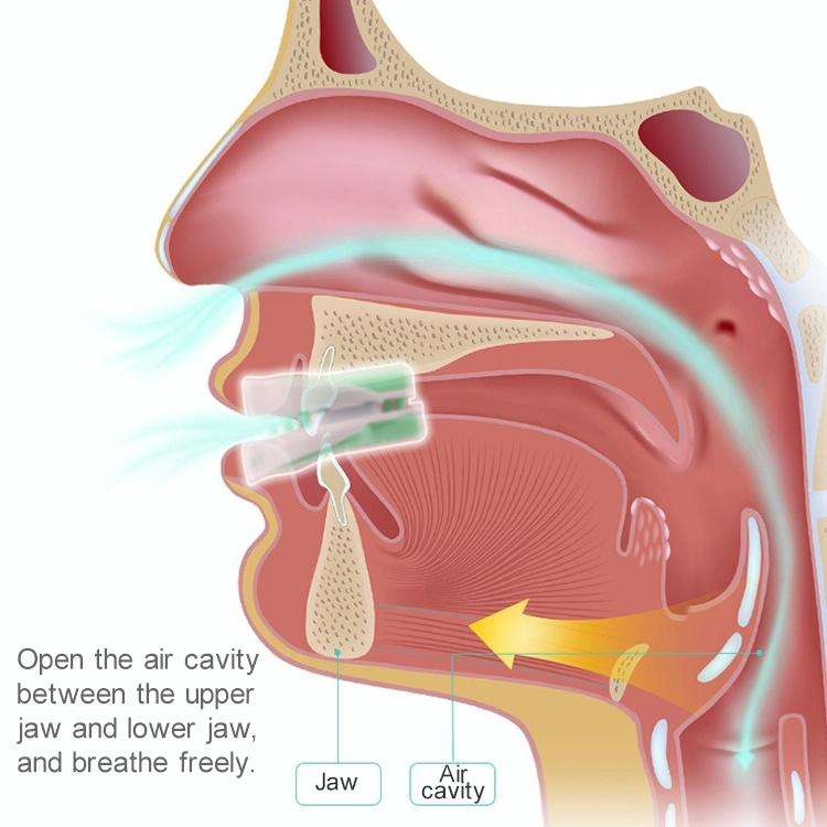 Yuknight Adult Home Throat Anti-snoring Mouthguard Device