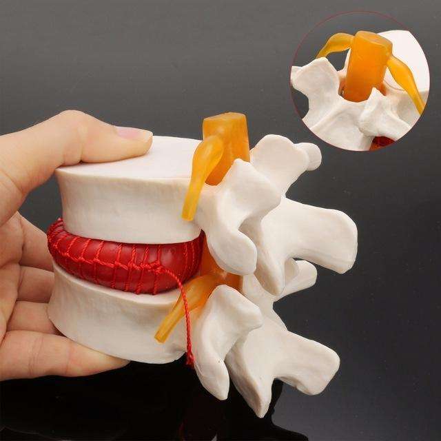 Human Lumbar Disc Herniation Demonstration Model Orthopedic Spine Model(Yellow)