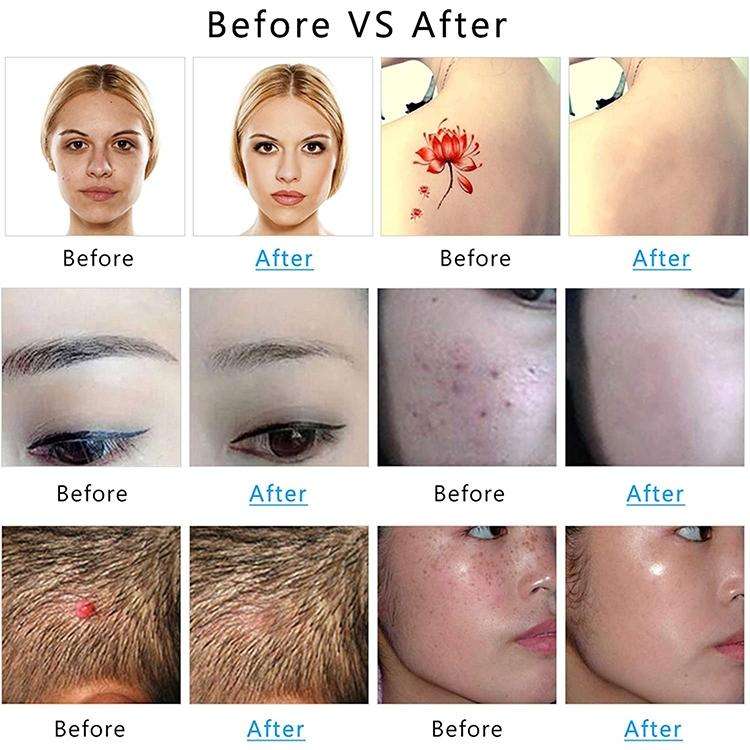 AA-A401 Small Freckle and Mole Removal Pen Tattoo and Eyebrow Removal Beauty Instrument, Color: B...