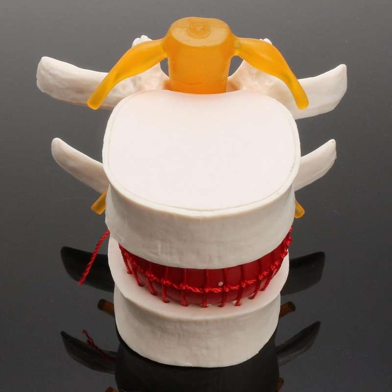 Human Lumbar Disc Herniation Demonstration Model Orthopedic Spine Model(Yellow)