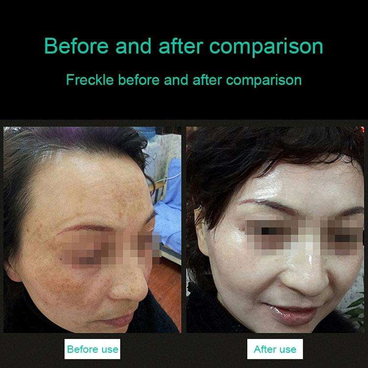 Handheld Picosecond Portable ( Removing Tattoo Freckle Mole Dot) Machine Laser Plasma Beauty Care...
