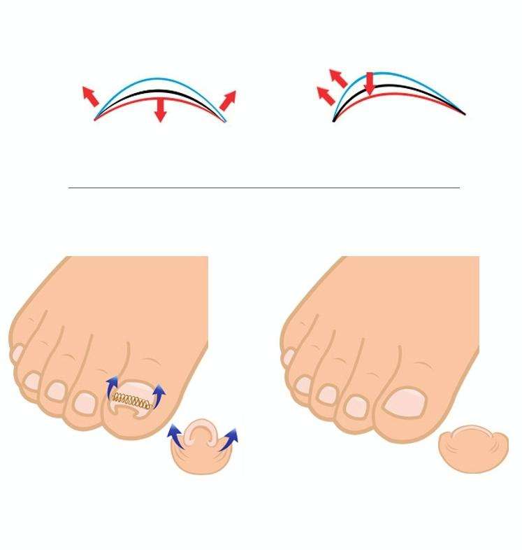 12 in 1 Toenail Orthosis With Ingrown Toenails
