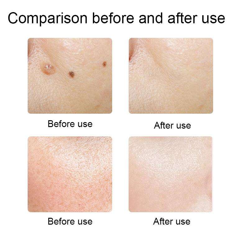 FY-106 Portable Mole and Freckle Removal Pen Household Laser Beauty Equipment(Rose Gold)
