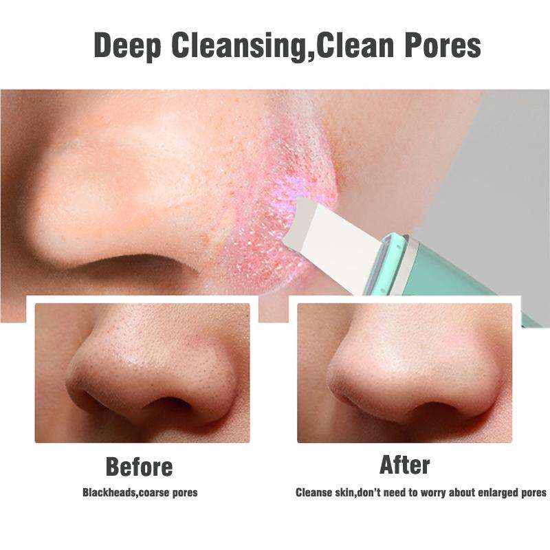 Ultrasonic Shoveling Machine Blackhead Beauty Instrument Iontophoresis Pore Cleaning Instrument(W...