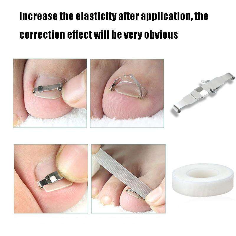 Orthopedic Buckle Toe Nail Groove Ingrown Nail Corrector, Style:No. 40, Specifications:Positive N...