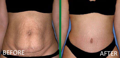 Tummy Tuck Slimming System