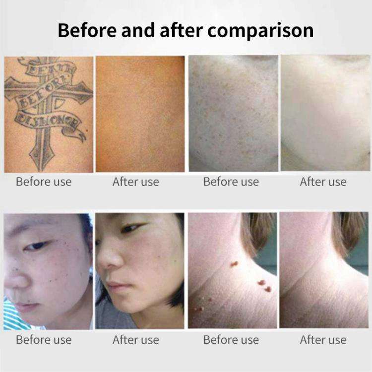 AA-A401 Portable Laser Beauty Instrument Mole Removal Freckle Removal Beauty Laser Pen, Specifica...