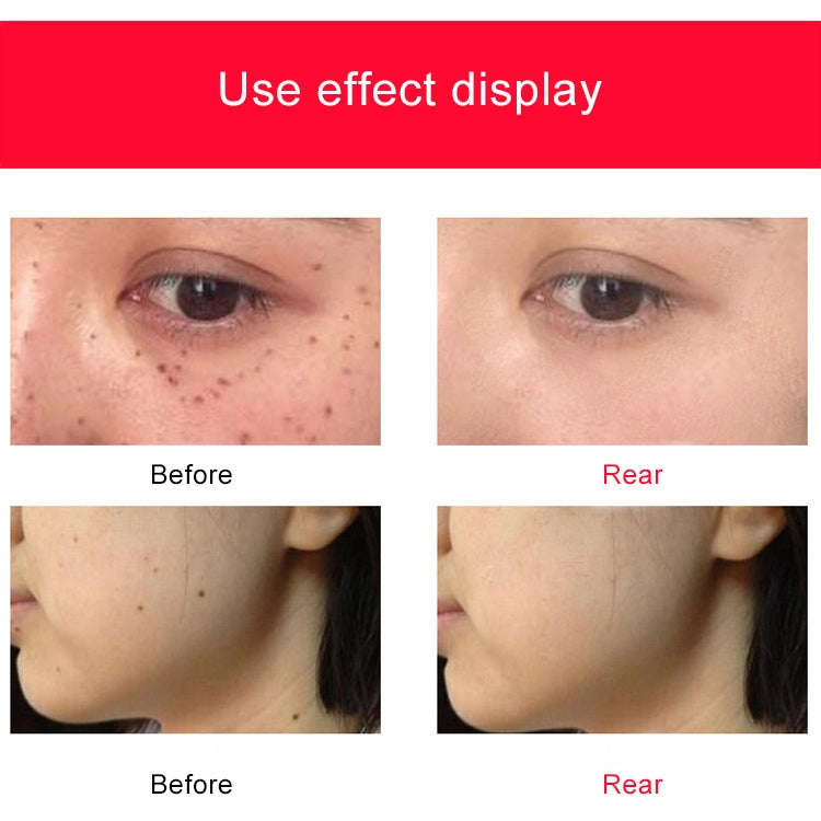 SONGSUN X2 Professional Portable Skin Spot Tattoo Freckle Removal Machine Mole Dot Removing Laser...