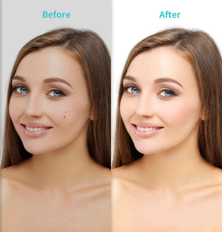 Xpreen XPRE061 Professional Dark Spot Remover Freckle Tattoo Chargeable Wart Mole Remover, with L...