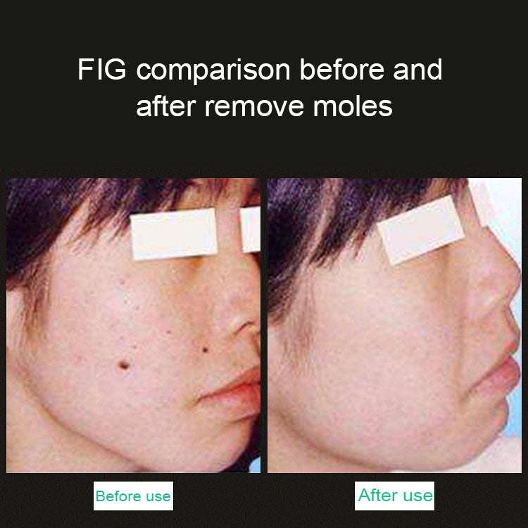 Handheld Picosecond Portable (Removing Tattoo Freckle Mole Dot)  Machine Laser Plasma Beauty Care...