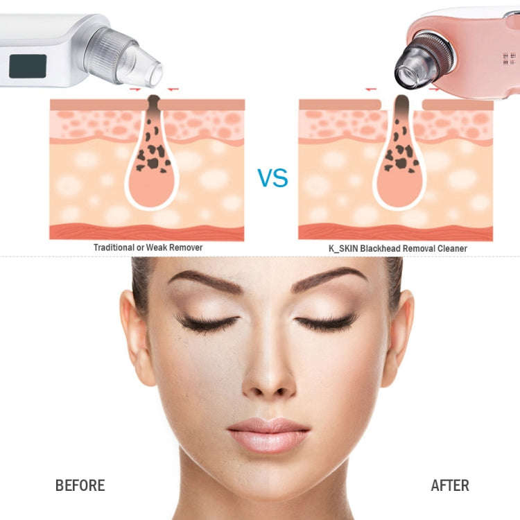 K-SKIN KD803A 3 Level Intensity Blackhead Removal Pore Cleaner Suction Rechargeable Black Spot Cl...