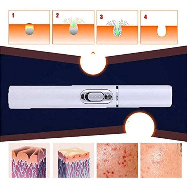 K-SKIN KD-7910 Acne Laser Pen Portable Wrinkle Removal Machine Durable Soft Scar Remover Device B...