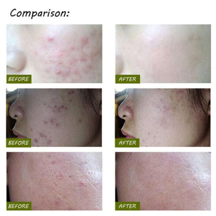 K-SKIN KD-7910 Acne Laser Pen Portable Wrinkle Removal Machine Durable Soft Scar Remover Device B...