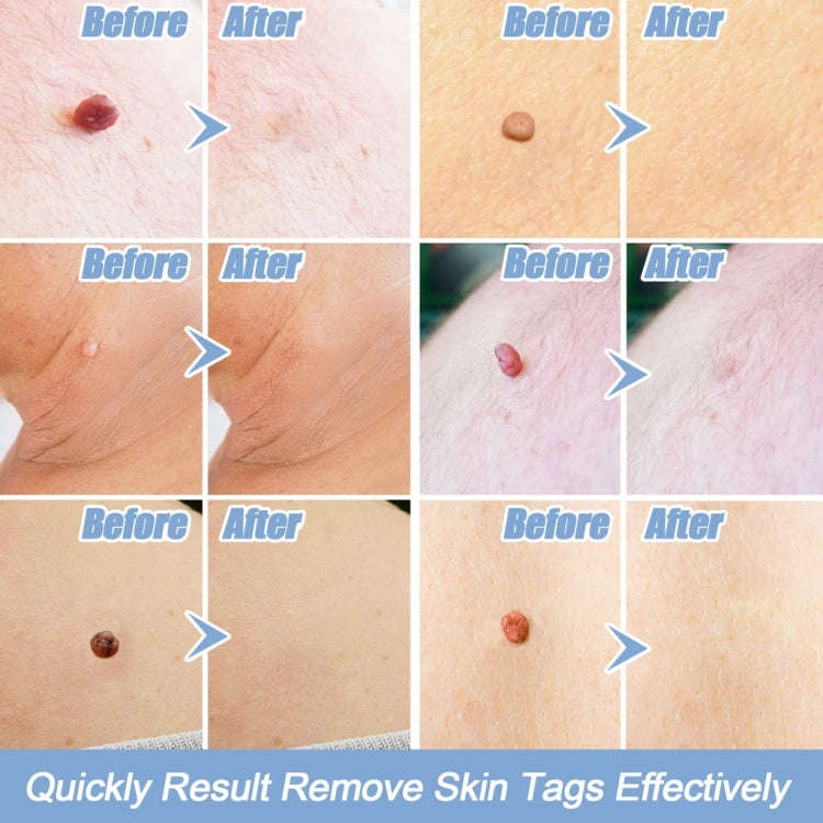 Skin Tag Removal Tool For 2mm-4mm Skin Tags Without Acne Patch