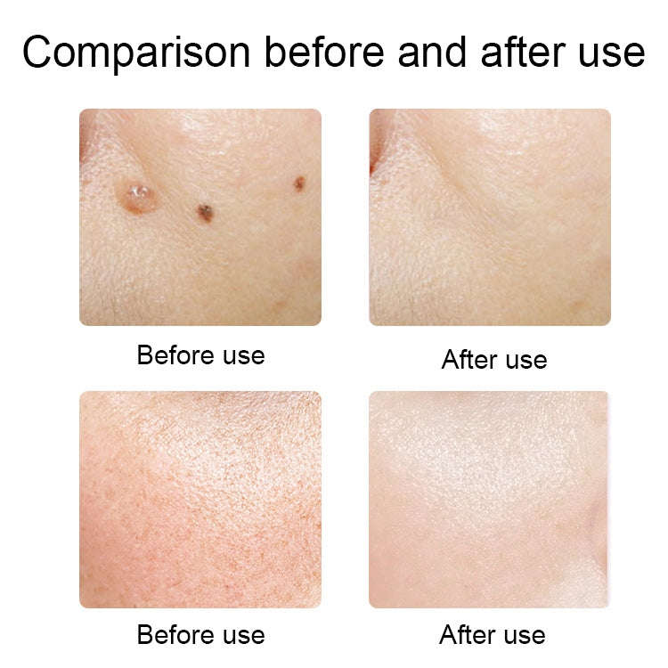 FY-106 Portable Mole and Freckle Removal Pen Household Laser Beauty Equipment(Green)