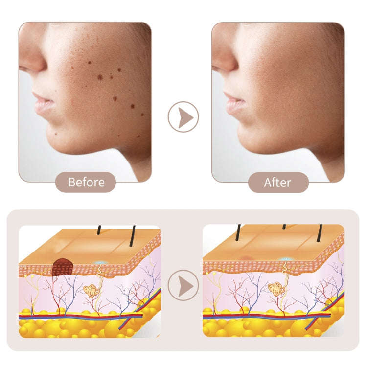 15 Gears Rechargeable Mole Spotting Pen Laser Beauty Instrument Spot Removal Magic Tool(Gold)