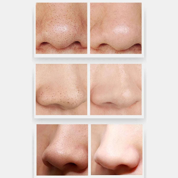 ZLY-018 Household Electric Blackhead Suction Device Pore Cleaning and Beauty Equipment(Standard)