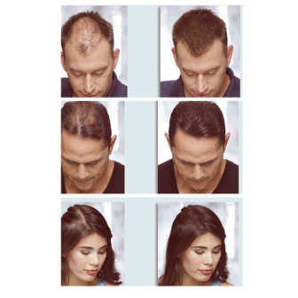 Anti Hair Loss Shampoo & Oil Combo