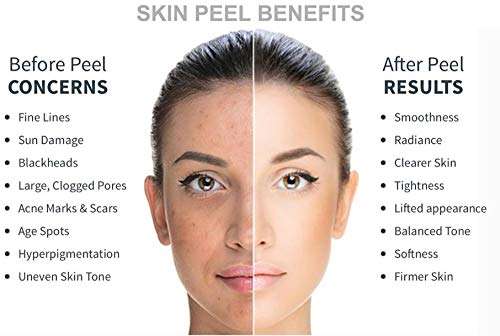 ASDM Beverly Hills Glycolic Acid Peel 2 FL OZ (40% Glycolic Acid 2 OZ)