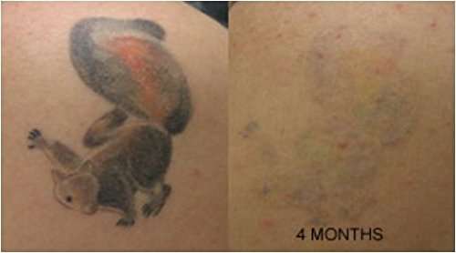 Tattoo Removal Cream Natural Fading system wrecking balm 4 week spartan perform