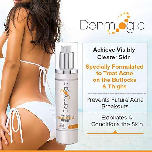 Anti-Acne Thigh & Buttocks Treatment - Clears Away Acne, Pimples, and Ingrown Hairs for the Butto...