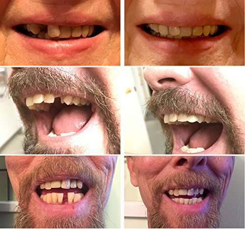 Instant Smile Temporary Tooth Kit - 3 Shades Included (Bright, Natural, Dark) - Does Not Stain an...