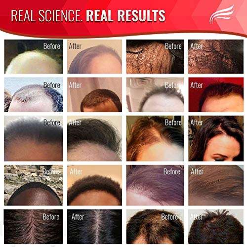2019 HAIR RESTORATION LABORATORIES' HAIR RESTORE DHT BLOCKING HAIR LOSS...