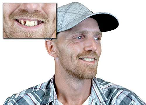 Instant Smile Temporary Tooth Kit - 3 Shades Included (Bright, Natural, Dark) - Does Not Stain an...