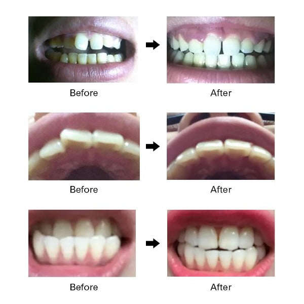 Teeth Aligner - Complete 3 stage Set - Adult - invisible